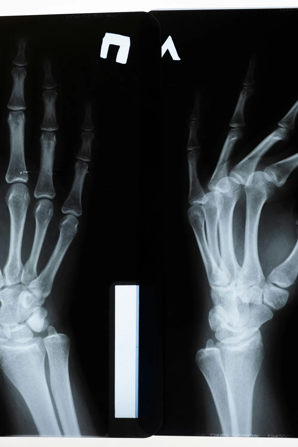 X-Ray of Injured Hand